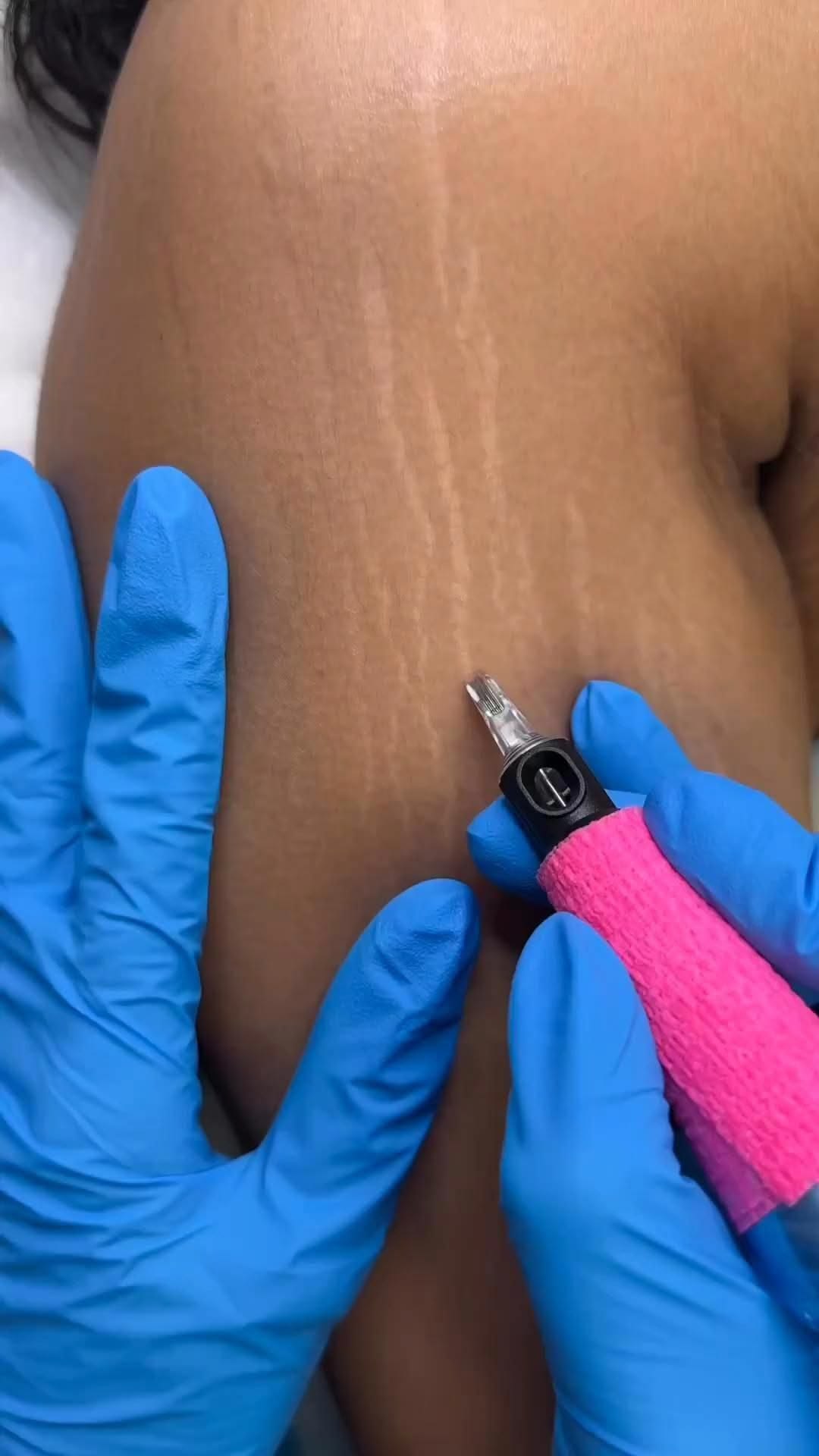 Mesoterapia