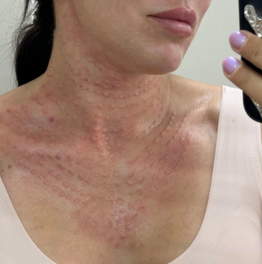 Mesoterapia