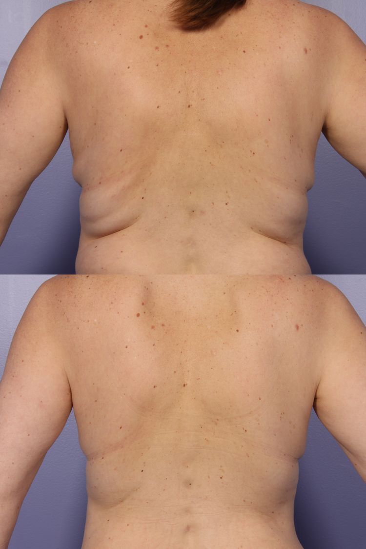 Mesoterapia