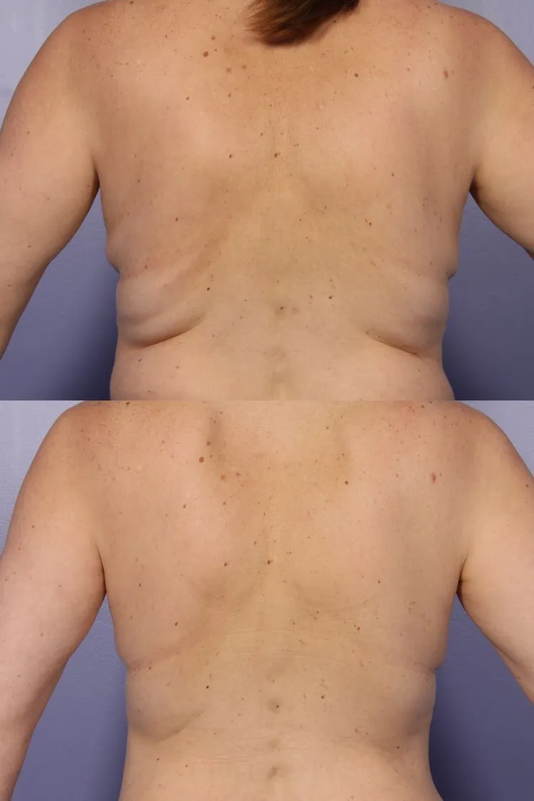 Mesoterapia
