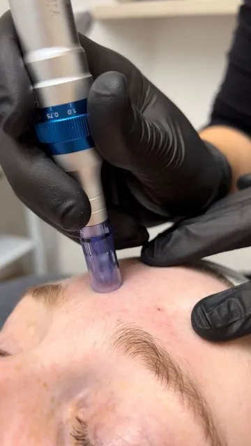 Microagulhamento